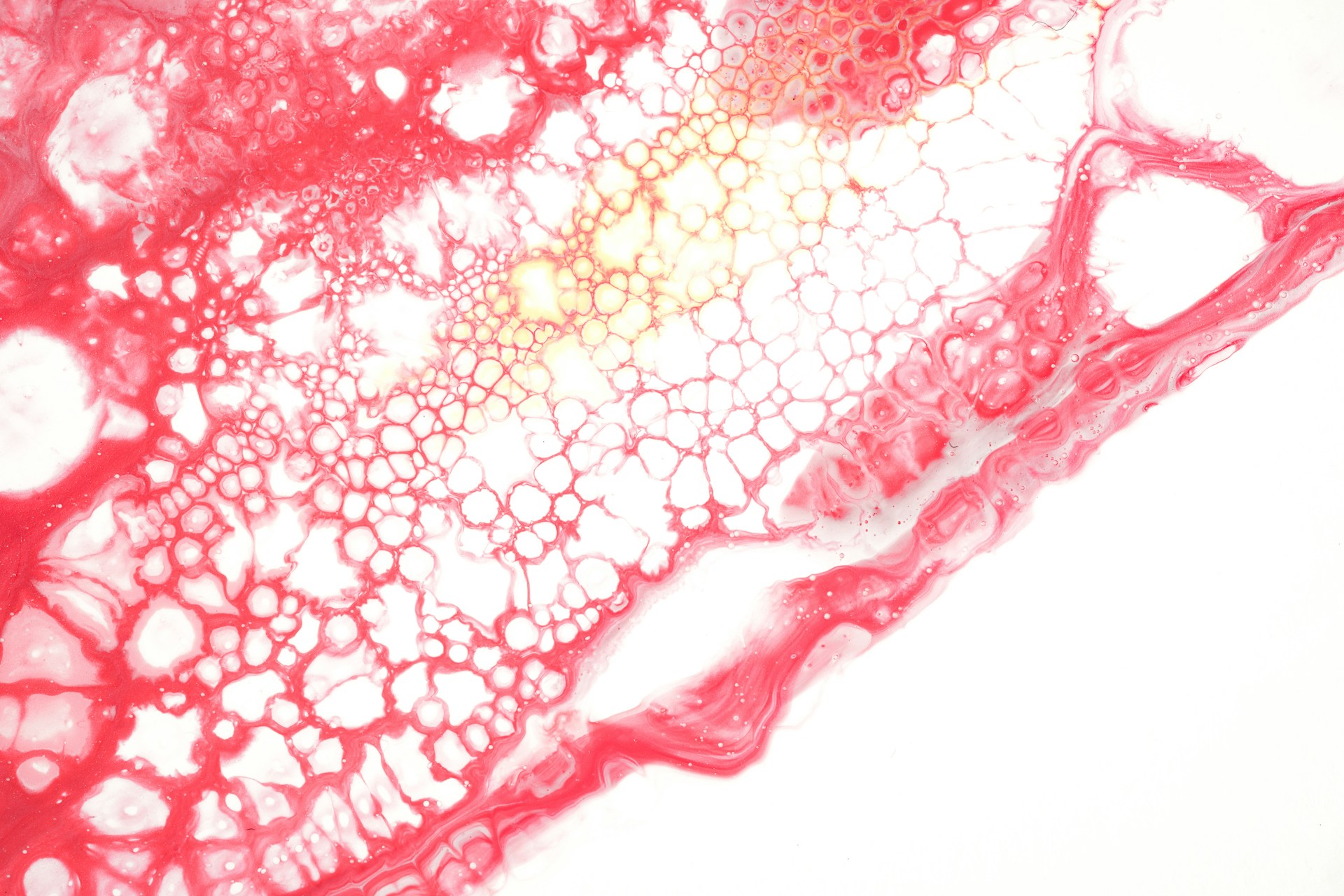 Varicose disease of the lower extremities: when "just veins" is a signal to act